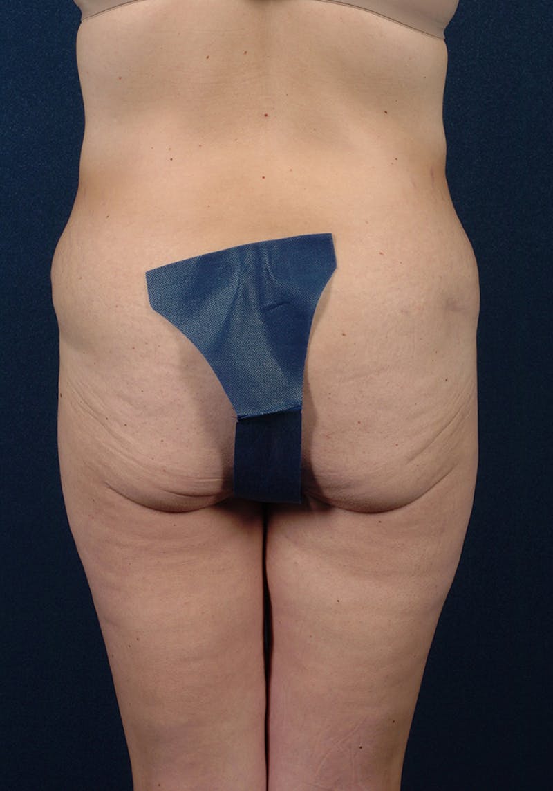 Lower Body Lift Before & After Gallery - Patient 9698343 - Image 7