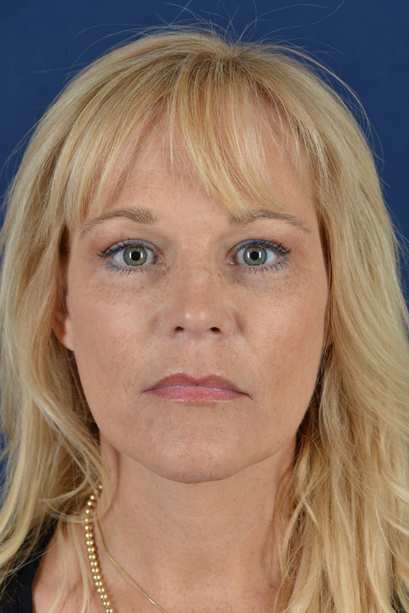 Facelift Before & After Gallery - Patient 9698345 - Image 2