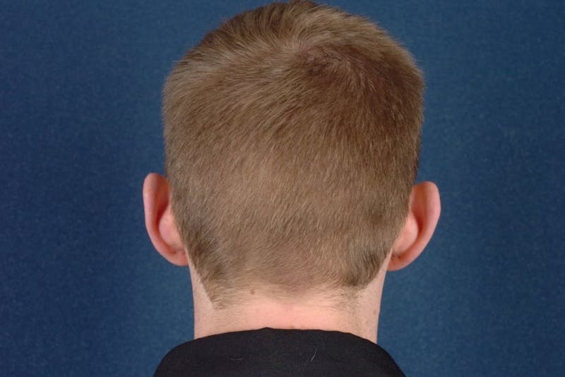 Otoplasty Before & After Gallery - Patient 9698354 - Image 3