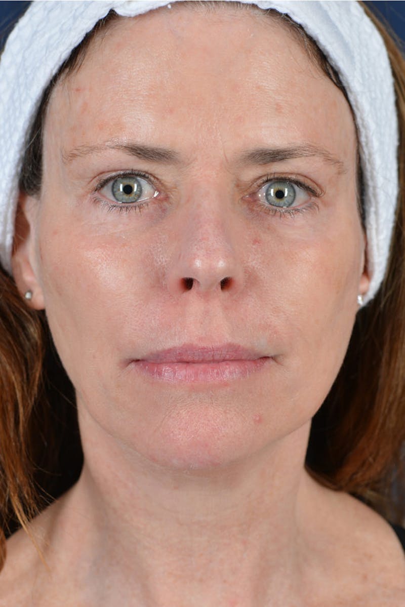 Facelift Before & After Gallery - Patient 9698356 - Image 2