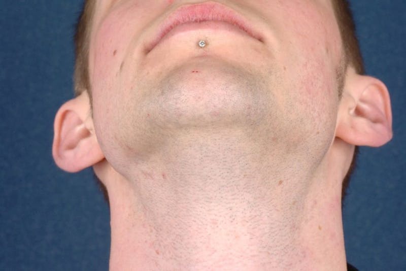 Otoplasty Before & After Gallery - Patient 9698354 - Image 5