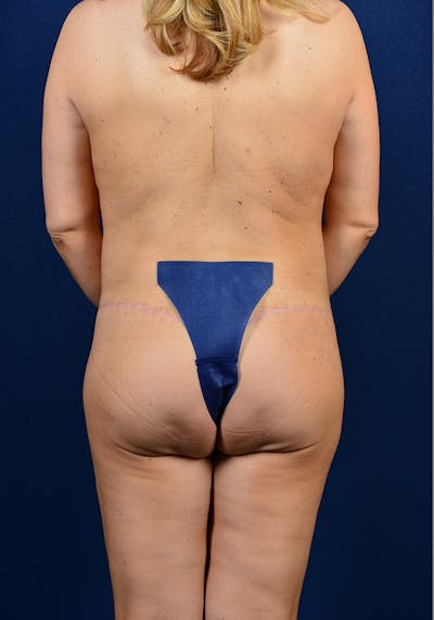 Lower Body Lift Before & After Gallery - Patient 9698355 - Image 8