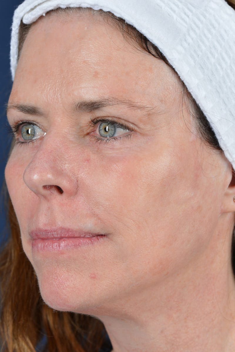 Facelift Before & After Gallery - Patient 9698356 - Image 4