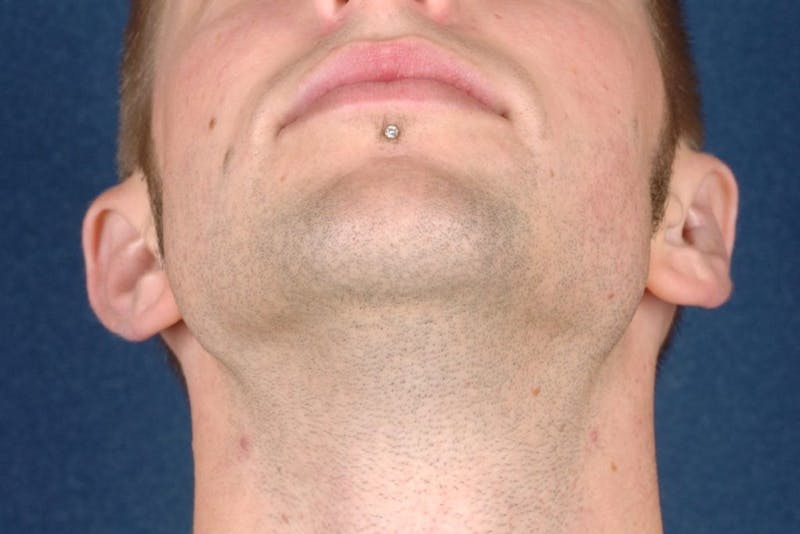 Otoplasty Before & After Gallery - Patient 9698354 - Image 6