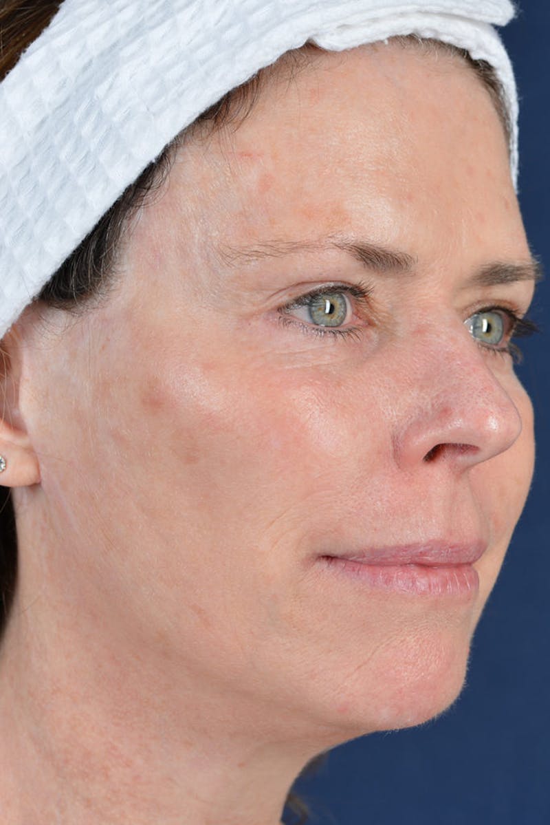 Facelift Before & After Gallery - Patient 9698356 - Image 6