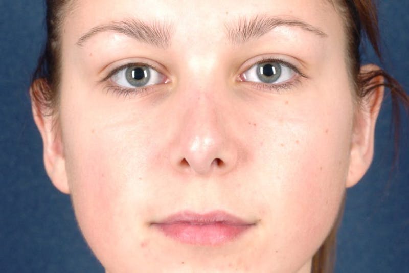 Otoplasty Before & After Gallery - Patient 9698362 - Image 2