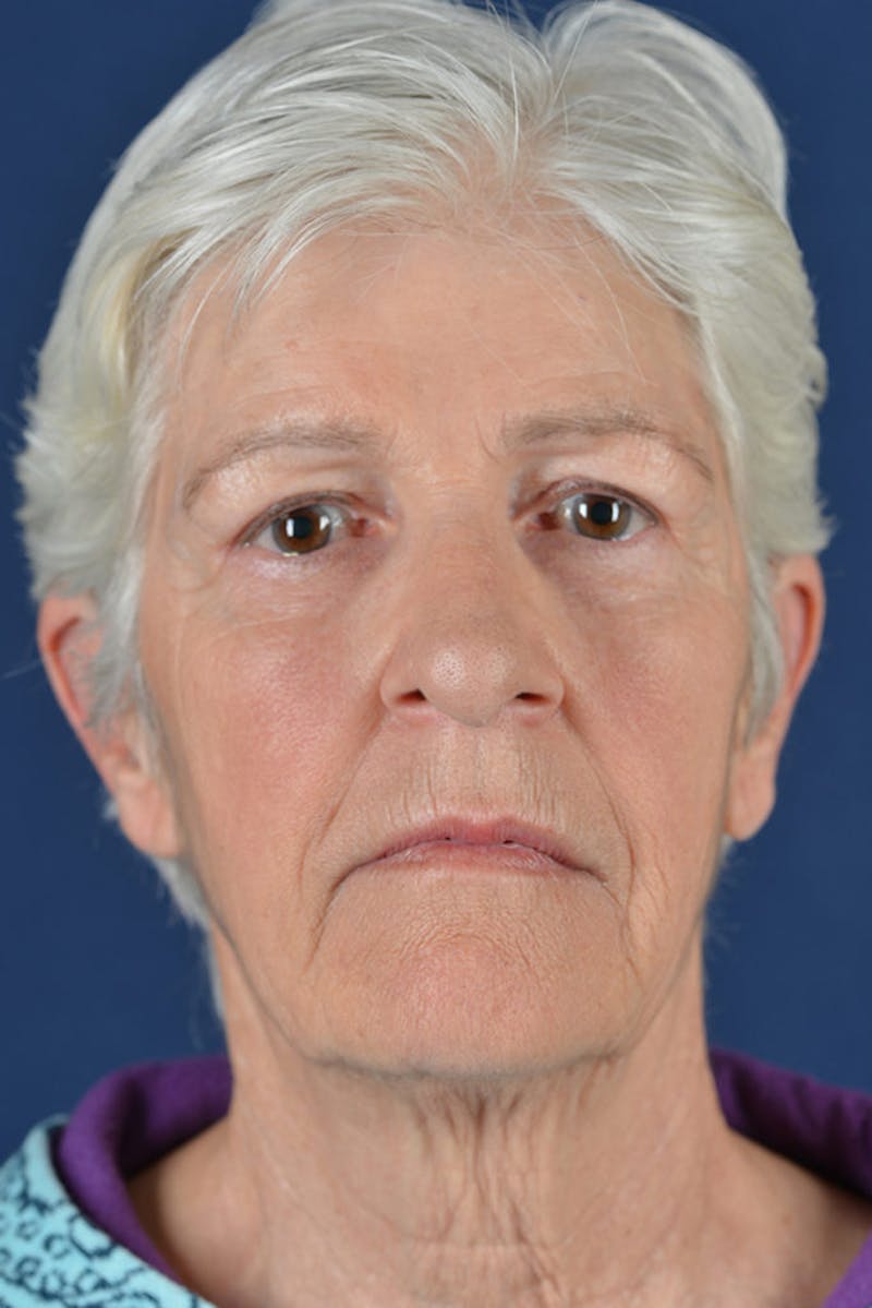Facelift Before & After Gallery - Patient 9698367 - Image 1