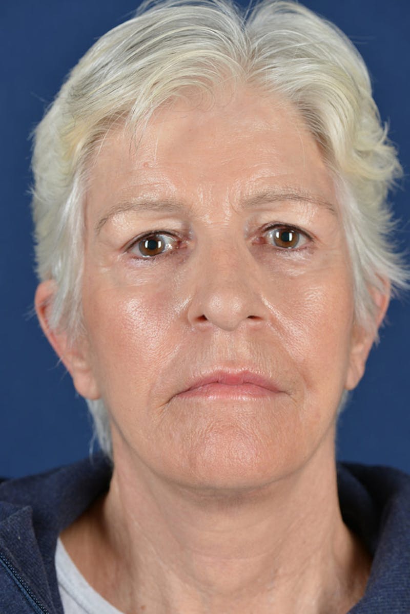Facelift Before & After Gallery - Patient 9698367 - Image 2