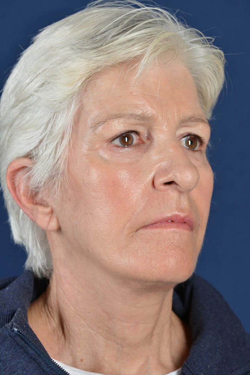 Facelift Before & After Gallery - Patient 9698367 - Image 4