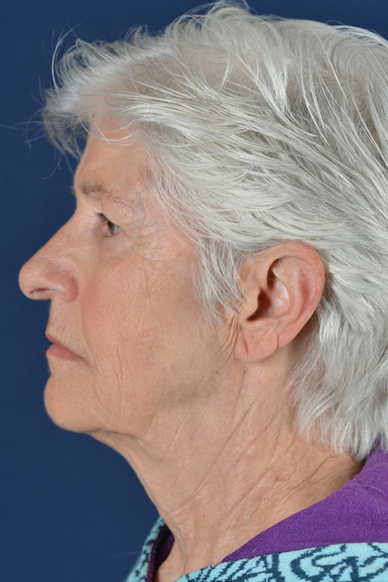 Facelift Before & After Gallery - Patient 9698367 - Image 5