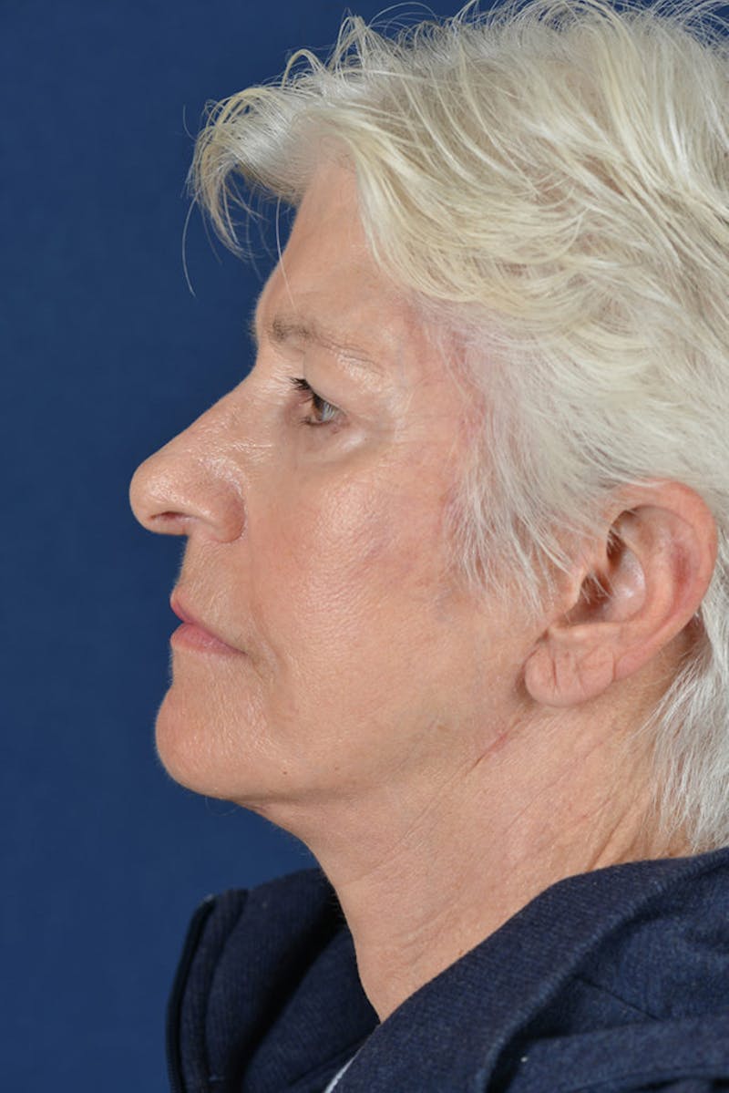 Facelift Before & After Gallery - Patient 9698367 - Image 6