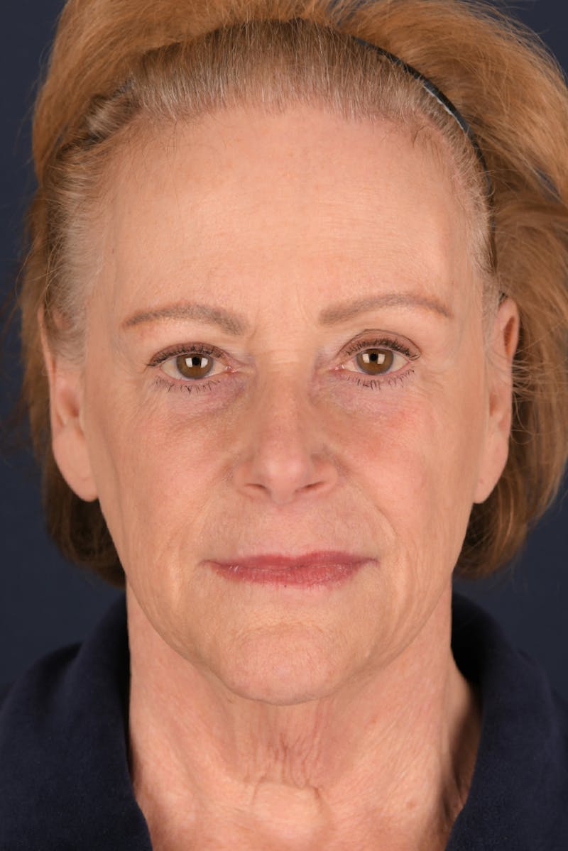 Facelift Before & After Gallery - Patient 9698374 - Image 1