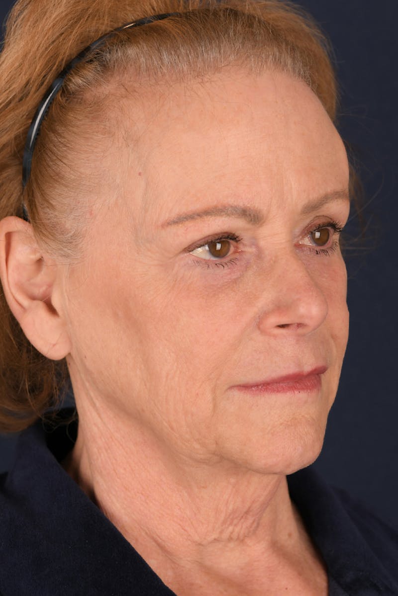 Facelift Before & After Gallery - Patient 9698374 - Image 3