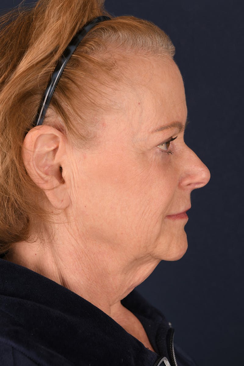 Facelift Before & After Gallery - Patient 9698374 - Image 5