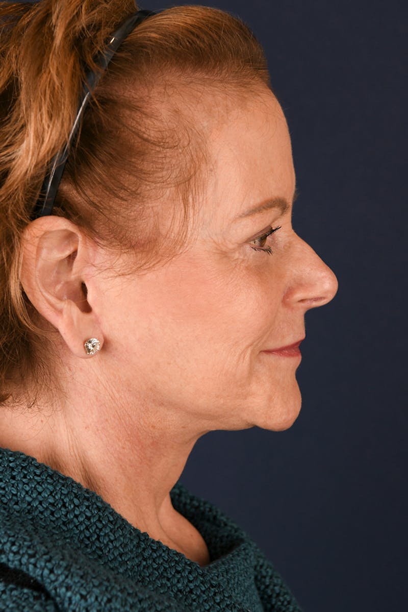 Facelift Before & After Gallery - Patient 9698374 - Image 6