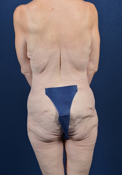 Lower Body Lift Before & After Gallery - Patient 9708884 - Image 7