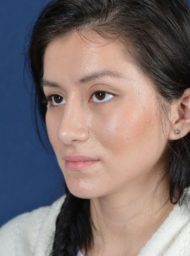 Rhinoplasty Before & After Gallery - Patient 9708893 - Image 4