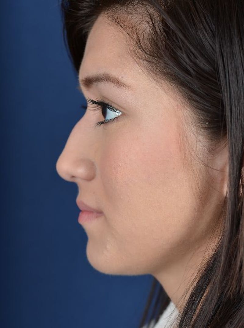 Rhinoplasty Before & After Gallery - Patient 9708893 - Image 5