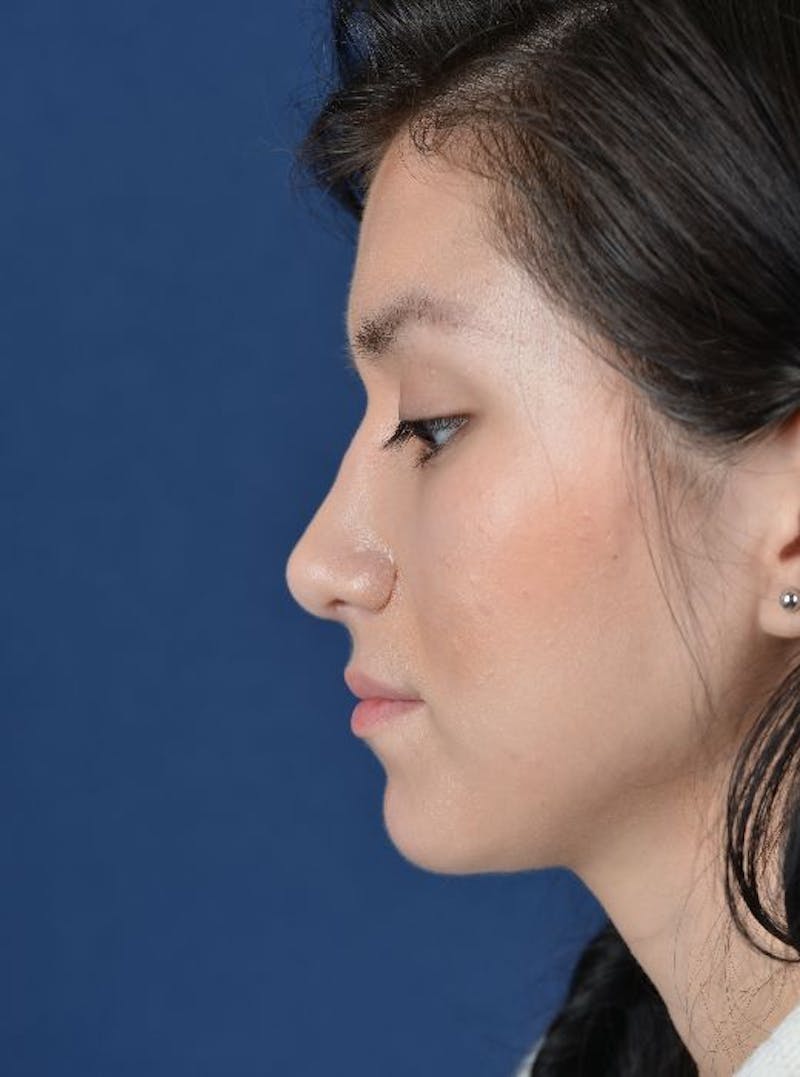 Rhinoplasty Before & After Gallery - Patient 9708893 - Image 6