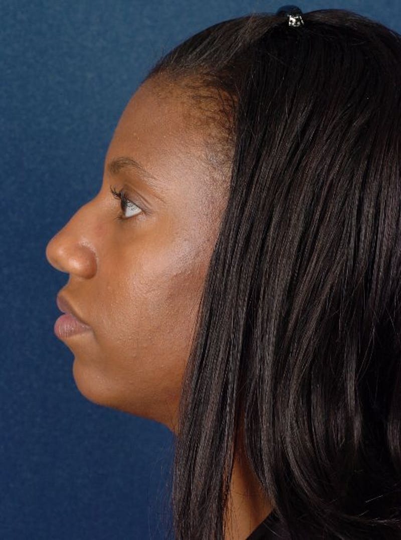 Rhinoplasty Before & After Gallery - Patient 9708902 - Image 3