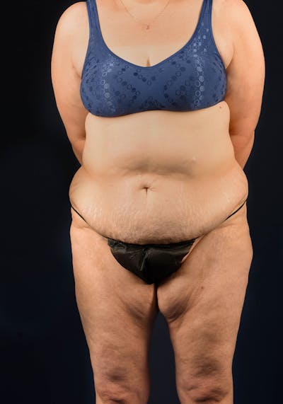 Lower Body Lift Before & After Gallery - Patient 9708905 - Image 1