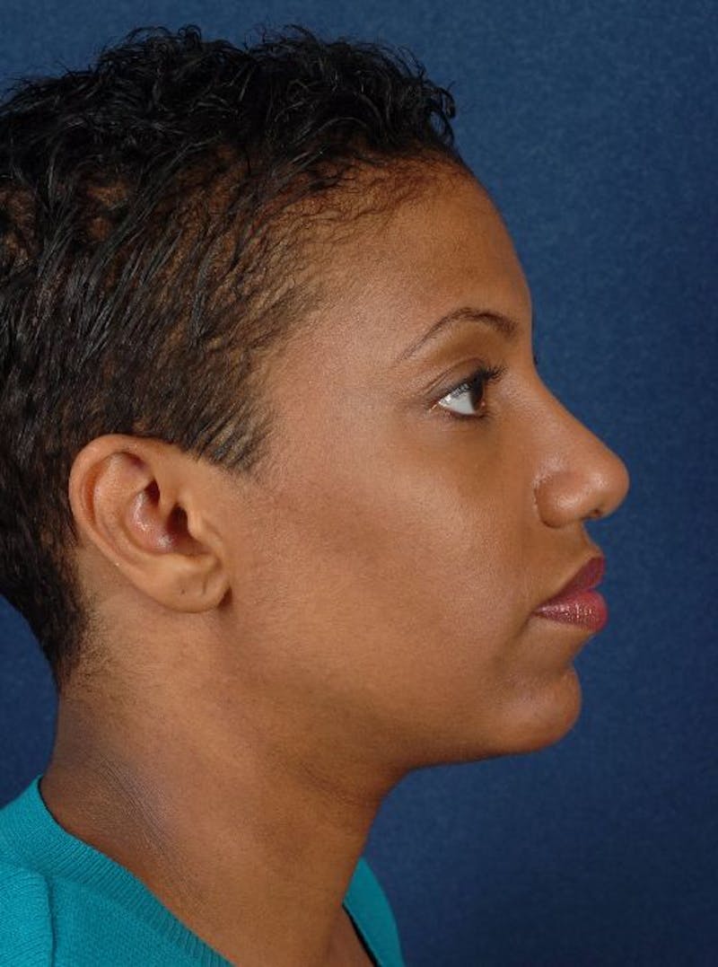 Rhinoplasty Before & After Gallery - Patient 9708902 - Image 6
