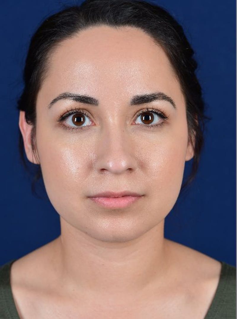 Rhinoplasty Before & After Gallery - Patient 9708906 - Image 1