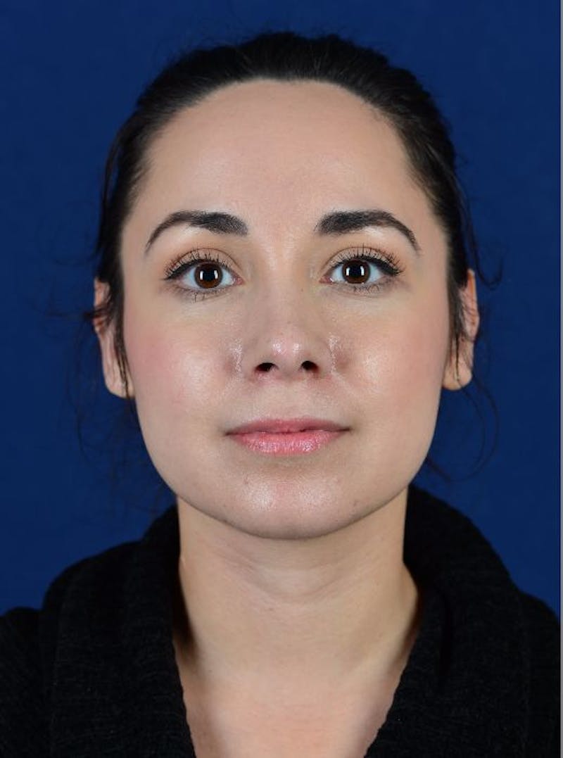 Rhinoplasty Before & After Gallery - Patient 9708906 - Image 2