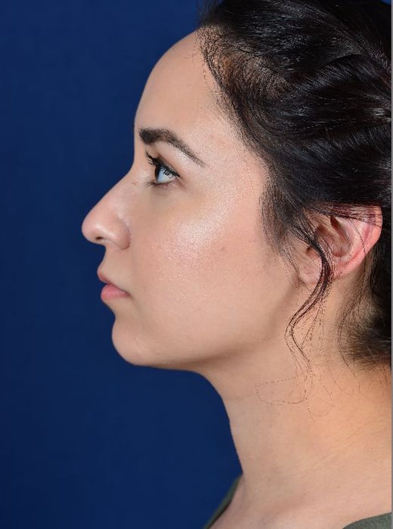 Rhinoplasty Before & After Gallery - Patient 9708906 - Image 3