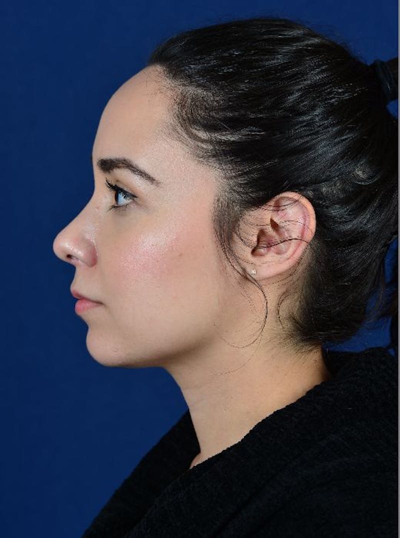 Rhinoplasty Before & After Gallery - Patient 9708906 - Image 4