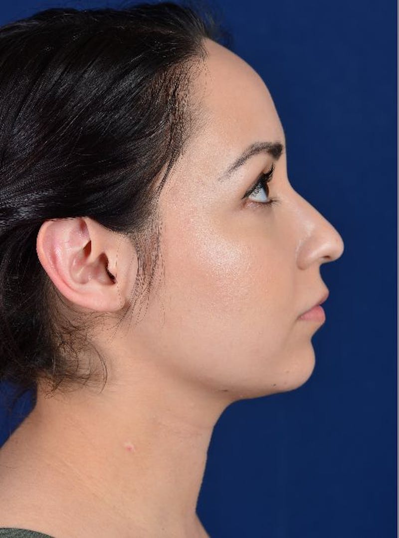 Rhinoplasty Before & After Gallery - Patient 9708906 - Image 5