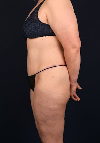 Lower Body Lift Before & After Gallery - Patient 9708905 - Image 6