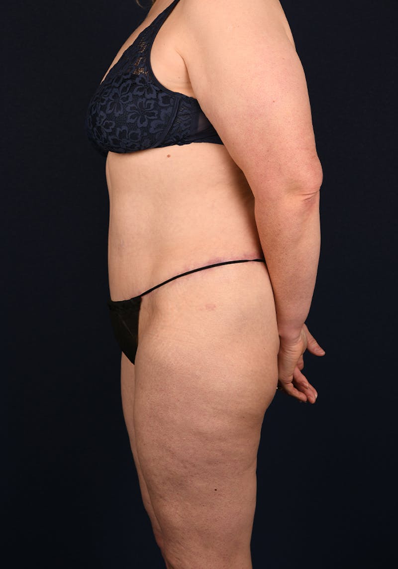 Lower Body Lift Before & After Gallery - Patient 9708905 - Image 6