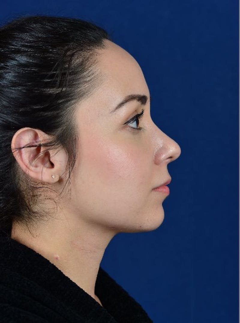 Rhinoplasty Before & After Gallery - Patient 9708906 - Image 6