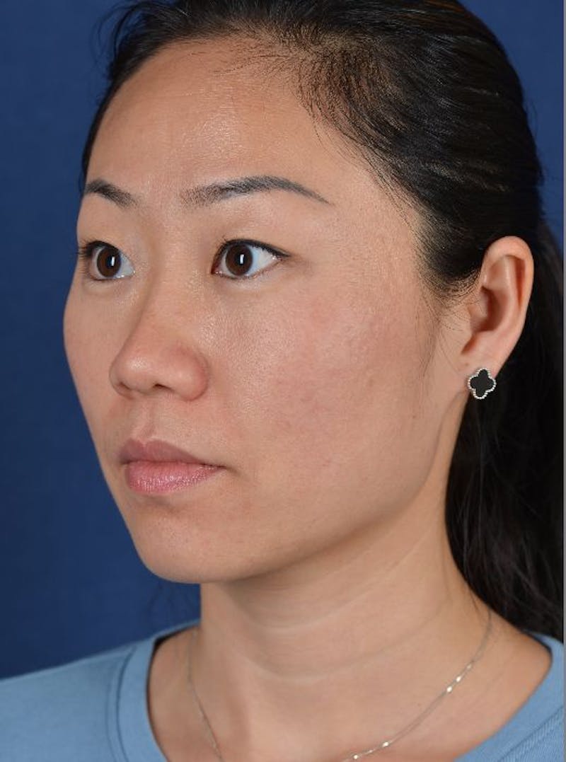 Rhinoplasty Before & After Gallery - Patient 9708912 - Image 3