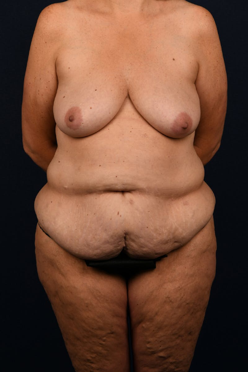 Lower Body Lift Before & After Gallery - Patient 9708935 - Image 1