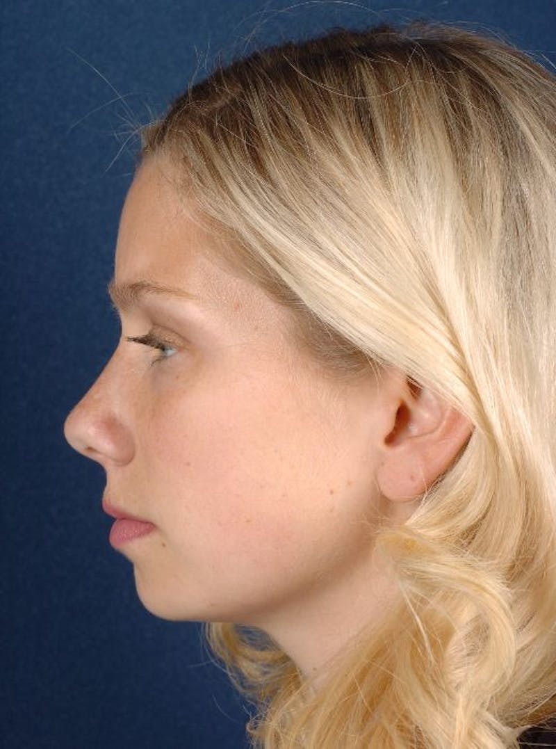 Rhinoplasty Before & After Gallery - Patient 9708934 - Image 5