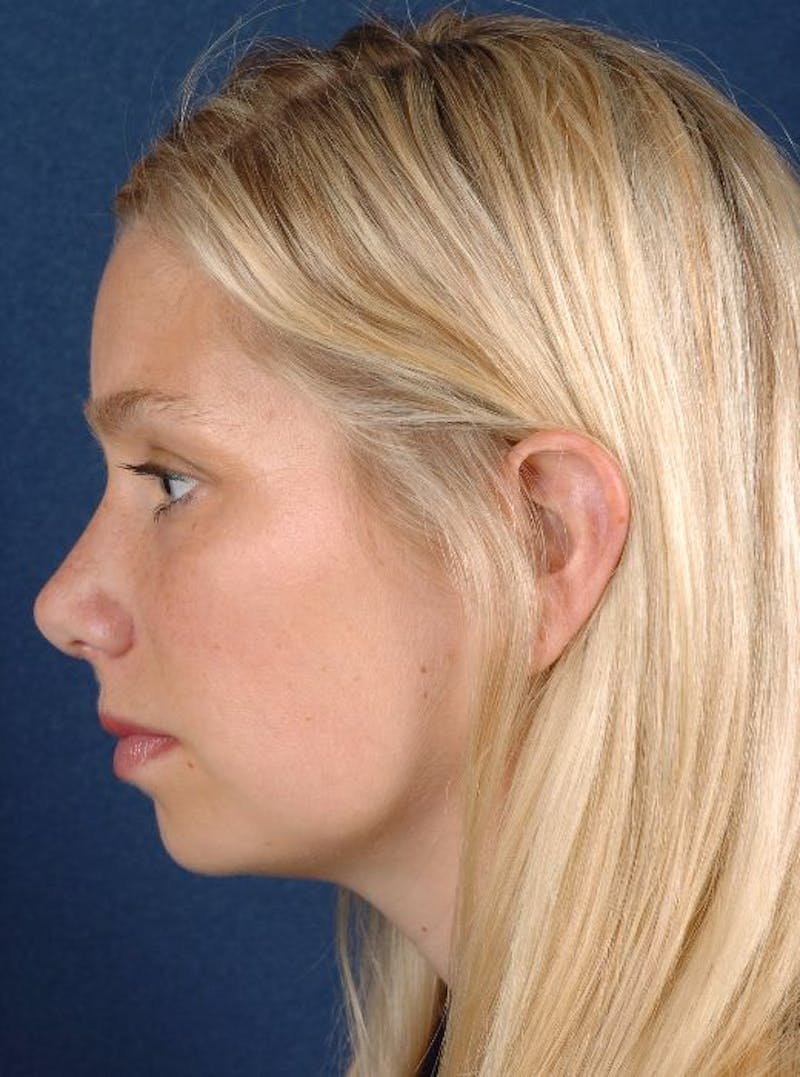 Rhinoplasty Before & After Gallery - Patient 9708934 - Image 6