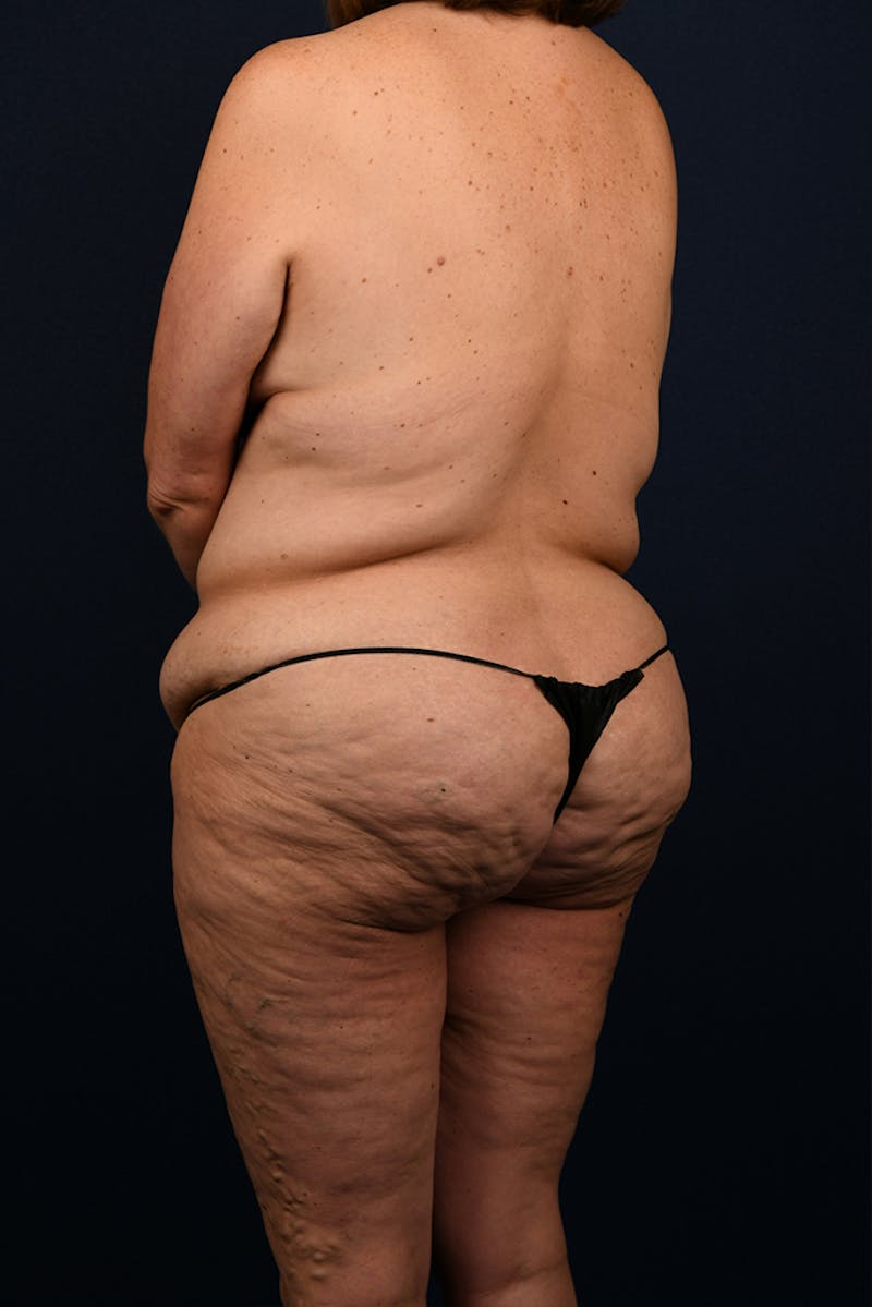Lower Body Lift Before & After Gallery - Patient 9708935 - Image 5