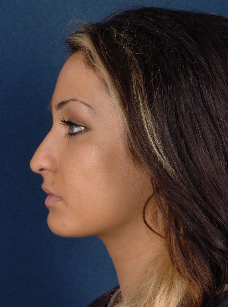 Rhinoplasty Before & After Gallery - Patient 9708936 - Image 3