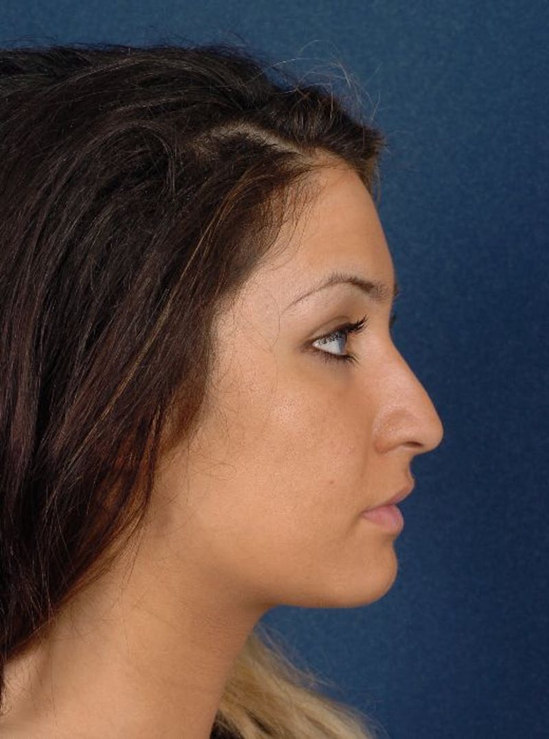 Rhinoplasty Before & After Gallery - Patient 9708936 - Image 5