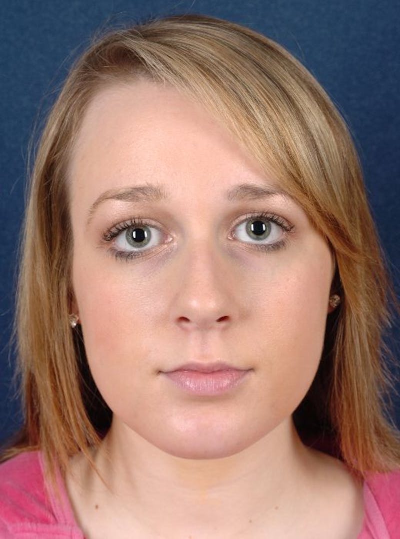 Rhinoplasty Before & After Gallery - Patient 9708938 - Image 1