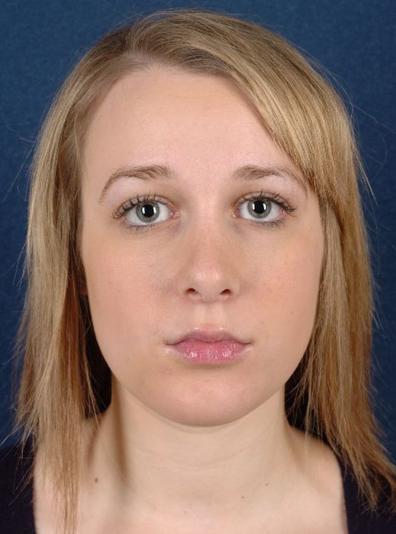 Rhinoplasty Before & After Gallery - Patient 9708938 - Image 2