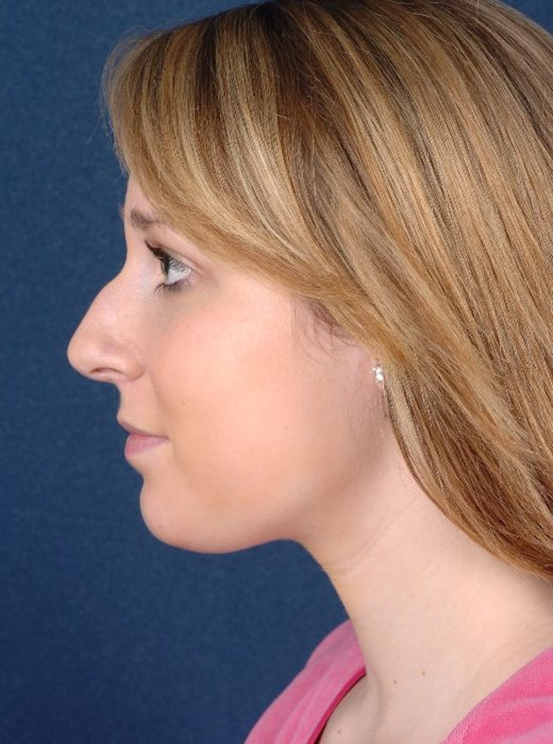 Rhinoplasty Before & After Gallery - Patient 9708938 - Image 3