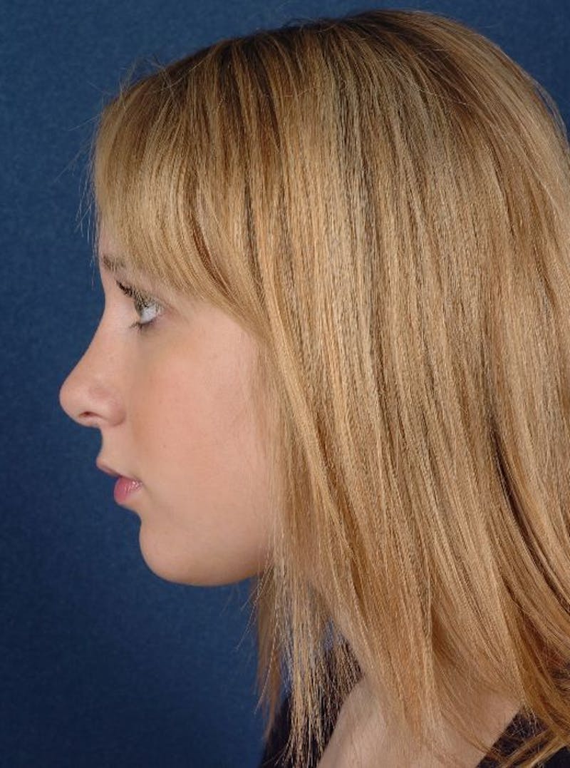 Rhinoplasty Before & After Gallery - Patient 9708938 - Image 4
