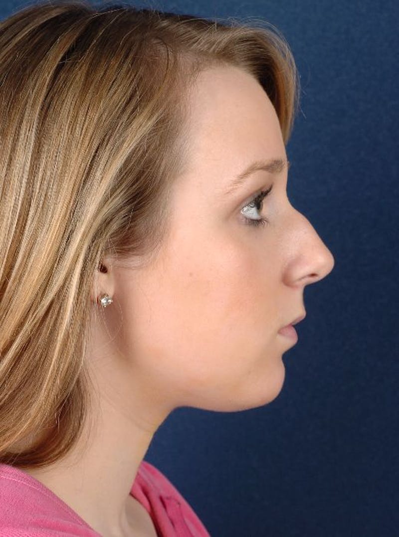 Rhinoplasty Before & After Gallery - Patient 9708938 - Image 5