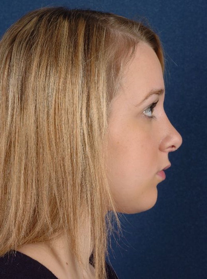 Rhinoplasty Before & After Gallery - Patient 9708938 - Image 6