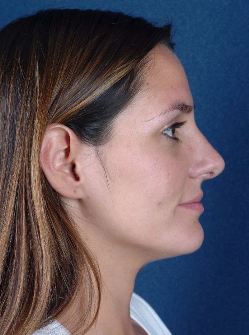 Rhinoplasty Before & After Gallery - Patient 9708943 - Image 4