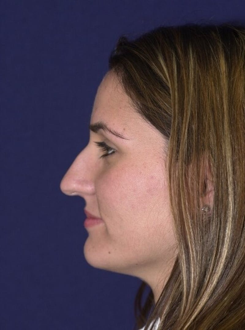 Rhinoplasty Before & After Gallery - Patient 9708943 - Image 5