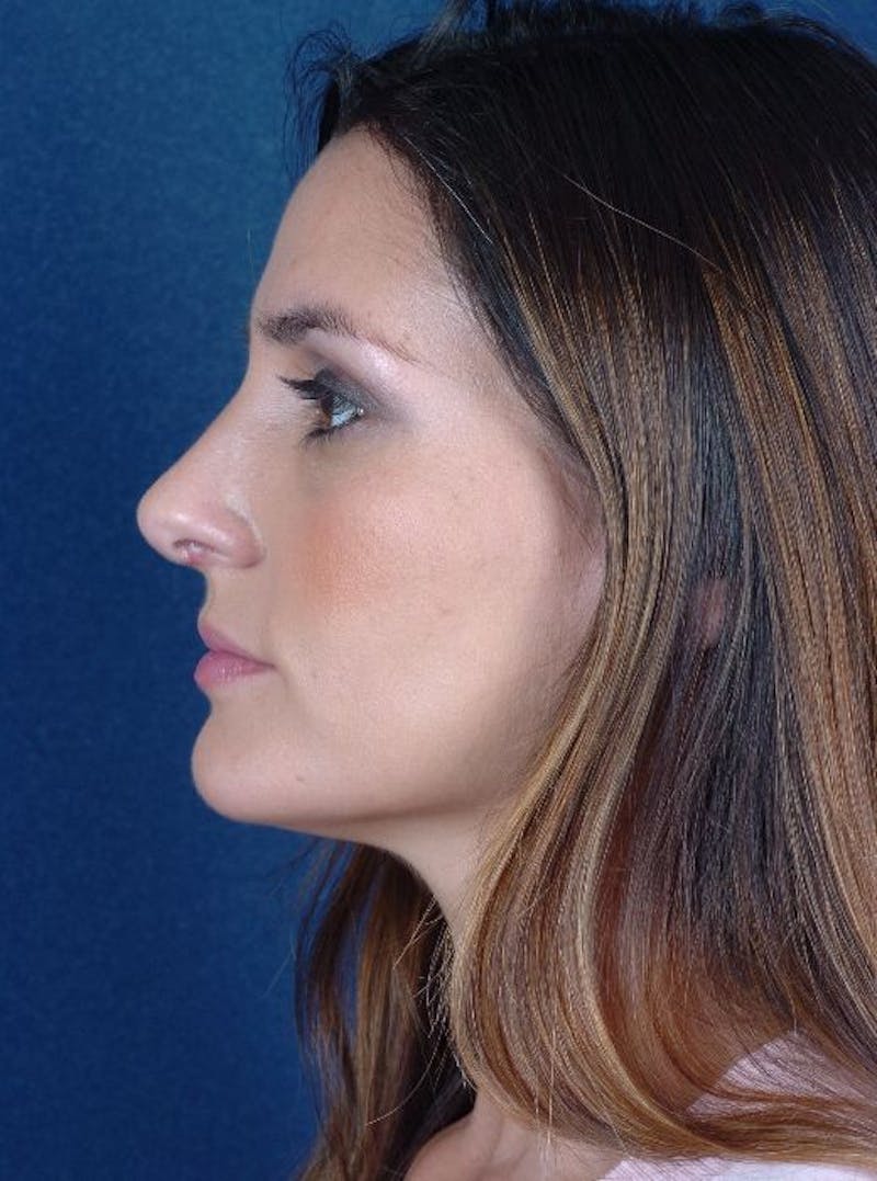 Rhinoplasty Before & After Gallery - Patient 9708943 - Image 6